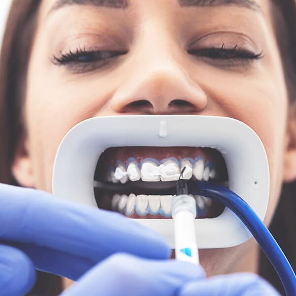 clareamento dental