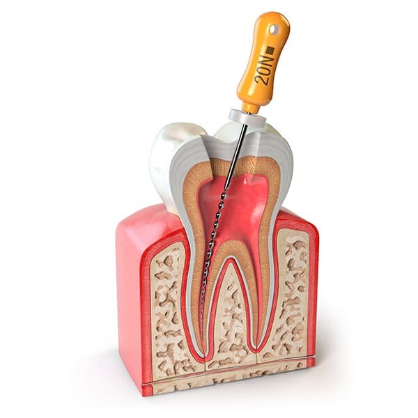 endodontista