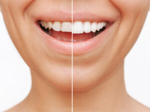 sorriso com imperfeições corrigidas pelas facetas dentárias