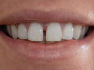 diastema