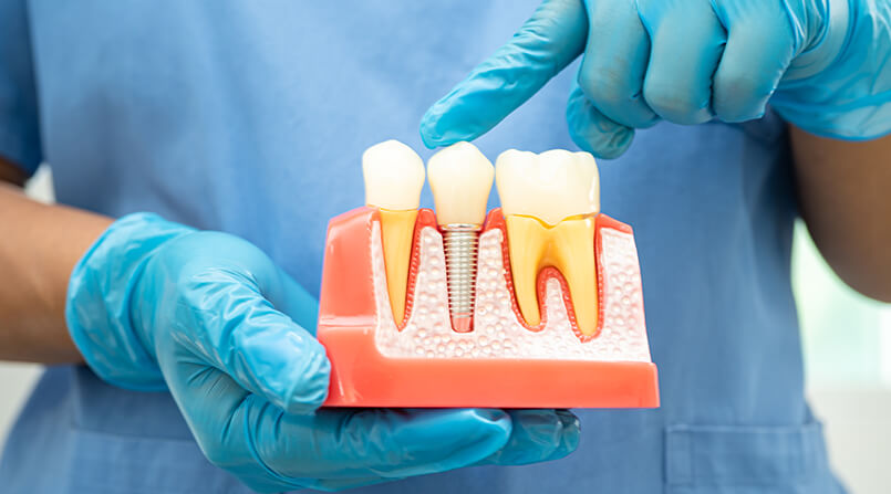 Tipos de implantes dentários