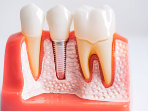 Tipos de implantes dentários