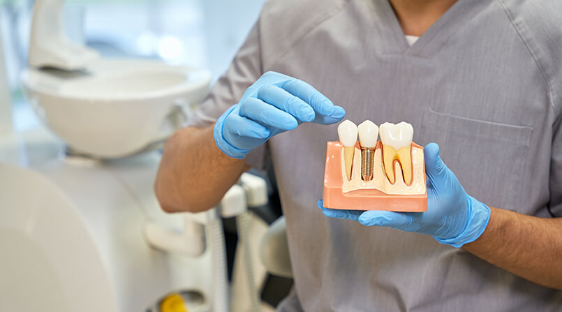 Quanto tempo duram os implantes dentários